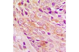 Immunohistochemical analysis of PI3K p110 alpha staining in human breast cancer formalin fixed paraffin embedded tissue section. (PIK3CA Antikörper  (Center))