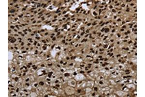 The image on the left is immunohistochemistry of paraffin-embedded Human esophagus cancer tissue using ABIN7189815(ANP32E Antibody) at dilution 1/20, on the right is treated with synthetic peptide. (ANP32E Antikörper)