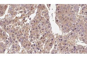 ABIN6269008 at 1/100 staining Human liver cancer tissue by IHC-P. (GLUT1 Antikörper  (C-Term))