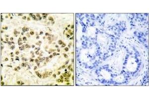 Immunohistochemistry analysis of paraffin-embedded human breast carcinoma, using STAT5B (Phospho-Ser731) Antibody. (STAT5B Antikörper  (pSer731))