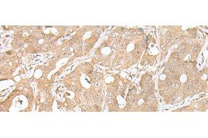 Immunohistochemistry of paraffin-embedded Human gastric cancer tissue using SMARCA1 Polyclonal Antibody at dilution of 1:30(x200) (SMARCA1 Antikörper)