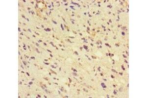 Immunohistochemistry of paraffin-embedded human glioma using ABIN7154022 at dilution of 1:100 (GLUL Antikörper  (AA 86-373))