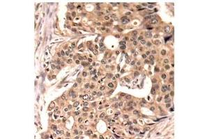 Immunohistochemistry of paraffin-embedded Human breast carcinoma tissue, using Phospho-PXN(Y118) Polyclonal Antibody (Paxillin Antikörper  (pTyr118))