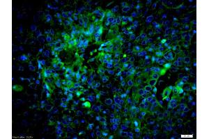 Formalin-fixed and paraffin embedded human laryngocarcinoma labeled with Anti-caspase-8 subunit p18 Polyclonal Antibody, Unconjugated (ABIN1386778) at 1:200 followed by conjugation to the secondary antibody Goat Anti-Rabbit IgG, AF488 conjugated used at 1:200 dilution for 40 minutes at 37°C and DAPI staining (Caspase 8 Antikörper  (AA 188-280))