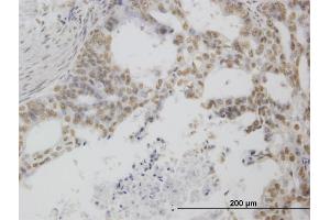 Immunoperoxidase of monoclonal antibody to POLR1C on formalin-fixed paraffin-embedded human pancreatic cancer. (POLR1C Antikörper  (AA 1-346))