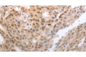 Immunohistochemistry of paraffin-embedded Human esophagus cancer tissue using SLC22A8 Polyclonal Antibody at dilution 1:70 (SLC22A8 Antikörper)