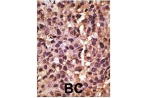 Formalin-fixed and paraffin-embedded human cancer tissue reacted with the primary antibody, which was peroxidase-conjugated to the secondary antibody, followed by DAB staining. (BNIP3 Antikörper  (AA 215-252))