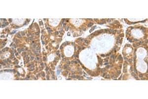 Immunohistochemistry of paraffin-embedded Human thyroid cancer tissue using KANSL1L Polyclonal Antibody at dilution of 1:80(x200) (KANSL1L Antikörper)