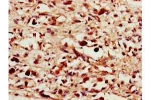 IHC image of ABIN7156872 diluted at 1:1400 and staining in paraffin-embedded human melanoma performed on a Leica BondTM system. (IL-24 Antikörper  (AA 52-207))
