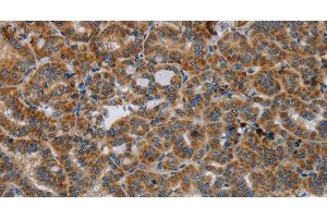 Immunohistochemistry of paraffin-embedded Human thyroid cancer tissue using HSD17B14 Polyclonal Antibody at dilution 1:40 (HSD17B14 Antikörper)