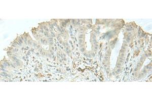 Immunohistochemistry of paraffin-embedded Human thyroid cancer tissue using C8orf4 Polyclonal Antibody at dilution of 1:55(x200)