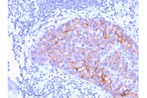 Formalin-fixed, paraffin-embedded human Breast Carcinoma stained with HER-2 Mouse Monoclonal Antibody (ERBB2/3078). (ErbB2/Her2 Antikörper  (AA 311-462))