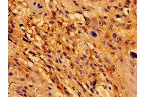 Immunohistochemistry of paraffin-embedded human cervical cancer using ABIN7172450 at dilution of 1:100