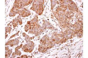 IHC-P Image ARF5 antibody detects ARF5 protein at cytosol on human breast carcinoma by immunohistochemical analysis. (ARF5 Antikörper)