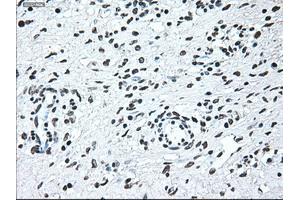 Immunohistochemical staining of paraffin-embedded Adenocarcinoma of breast tissue using anti-IRF3 mouse monoclonal antibody.