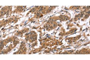 Immunohistochemistry of paraffin-embedded Human gastric cancer tissue using BNIP2 Polyclonal Antibody at dilution 1:50 (BNIP2 Antikörper)