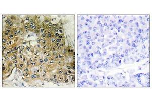 Immunohistochemical analysis of paraffin-embedded human breast carcinoma tissue using Integrin β1 (Phospho-Thr789) antibody (left)or the same antibody preincubated with blocking peptide (right). (ITGB1 Antikörper  (pThr789))