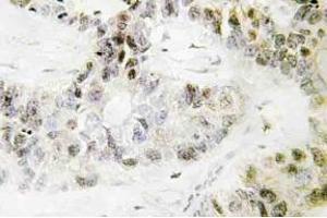 Immunohistochemistry (IHC) analyzes of Pitx1 antibody in paraffin-embedded human lung carcinoma tissue.