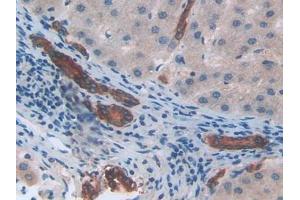 IHC-P analysis of Human Liver cancer Tissue, with DAB staining. (CXCL2 Antikörper  (AA 34-107))