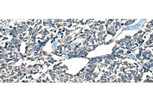 Immunohistochemistry of paraffin-embedded Human lung cancer tissue using CDADC1 Polyclonal Antibody at dilution of 1:60(x200) (CDADC1 Antikörper)