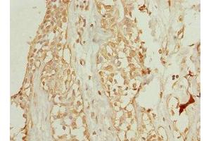 Immunohistochemistry of paraffin-embedded human breast cancer using ABIN7175750 at dilution of 1:100 (WDR38 Antikörper  (AA 1-314))