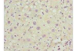 Immunohistochemistry of paraffin-embedded human liver cancer using ABIN7162977 at dilution of 1:100 (PEX14 Antikörper  (AA 118-377))