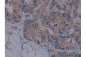 Detection of TICAM1 in Human Breast cancer Tissue using Polyclonal Antibody to Toll Like Receptor Adaptor Molecule 1 (TICAM1) (TICAM1 Antikörper  (AA 443-685))