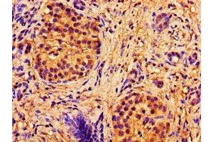 Immunohistochemistry of paraffin-embedded human pancreatic cancer using ABIN7144893 at dilution of 1:100 (ABCB7 Antikörper  (AA 23-140))