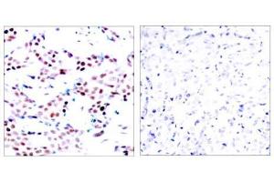 Immunohistochemical analysis of paraffin-embedded human breast carcinoma tissue using c-Jun (phospho-Thr91) antibody (E011021). (C-JUN Antikörper  (pThr91))