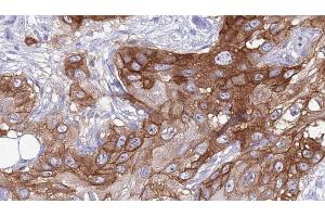 ABIN6273988 at 1/100 staining Human Head and neck cancer tissue by IHC-P. (RGR Antikörper  (Internal Region))
