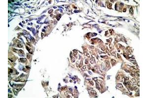 Human stomach cancer tissue was stained by rabbit Anti-Spexin prepro (36-58)  (H) Antibody (Spexin Antikörper  (Preproprotein))