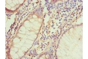 Immunohistochemistry of paraffin-embedded human colon cancer using ABIN7145332 at dilution of 1:100 (BNIP3L/NIX Antikörper  (AA 1-187))