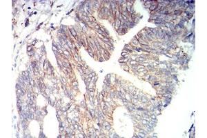 Immunohistochemical analysis of paraffin-embedded rectum cancer tissues using CD166 mouse mAb with DAB staining.