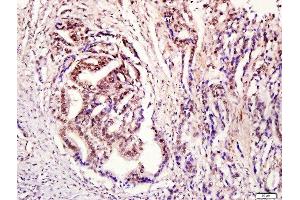 Paraformaldehyde-fixed, paraffin embedded human stomach cancer tissue, Antigen retrieval by boiling in sodium citrate buffer(pH6) for 15min, Block endogenous peroxidase by 3% hydrogen peroxide for 30 minutes, Blocking buffer (normal goat serum) at 37°C for 20min, Antibody incubation with Rabbit Anti-STAT3 (Tyr705) Polyclonal Antibody, Unconjugated  at 1:400 overnight at 4°C, followed by a conjugated secondary and DAB staining (STAT3 Antikörper  (pTyr705))
