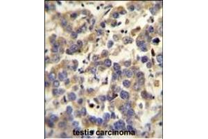 LYPD4 antibody (Center) (ABIN654302 and ABIN2844090) immunohistochemistry analysis in formalin fixed and paraffin embedded human testis carcinoma followed by peroxidase conjugation of the secondary antibody and DAB staining. (LYPD4 Antikörper  (AA 104-133))