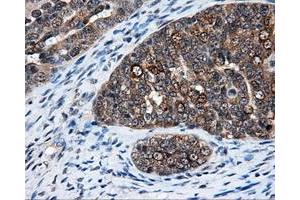 Immunohistochemical staining of paraffin-embedded Adenocarcinoma of breast tissue using anti-ELAVL1 mouse monoclonal antibody. (ELAVL1 Antikörper)