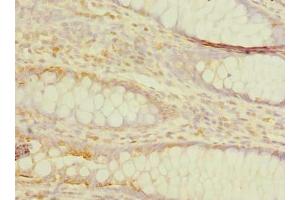 Immunohistochemistry of paraffin-embedded human colon cancer using ABIN7173249 at dilution of 1:100 (TMEM59L Antikörper  (AA 27-267))