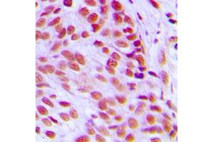 Immunohistochemical analysis of c-FOS staining in human breast cancer formalin fixed paraffin embedded tissue section.