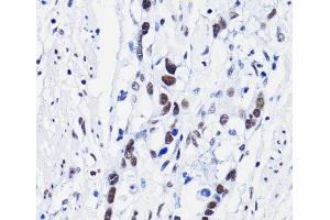 Immunohistochemistry of paraffin-embedded Human gastric cancer using Acetyl-Histone H4-K8 Polyclonal Antibody at dilution of 1:100 (40x lens). (Histone H4 Antikörper  (acLys8))