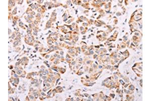 The image on the left is immunohistochemistry of paraffin-embedded Human breast cancer tissue using ABIN7189654(ADAMTS16 Antibody) at dilution 1/50, on the right is treated with synthetic peptide. (ADAMTS16 Antikörper)