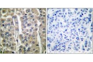 Immunohistochemistry analysis of paraffin-embedded human breast carcinoma tissue, using Involucrin Antibody. (Involucrin Antikörper  (AA 536-585))