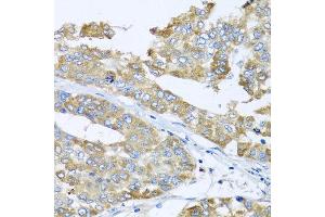 Immunohistochemistry of paraffin-embedded human liver cancer using COQ7 antibody at dilution of 1:100 (x40 lens). (Coq7 Antikörper)