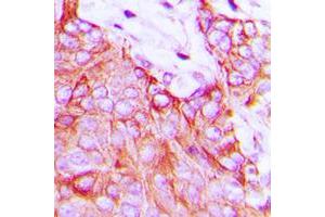 Immunohistochemical analysis of Ephrin A5 staining in human breast cancer formalin fixed paraffin embedded tissue section.