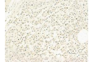 ABIN6263911 and ABIN6278220 at 1/100 staining human Hodgkin lymphoma by IHC-P. (OSR1 Antikörper  (C-Term))