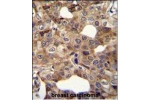 CCNI2 Antibody (Center) (ABIN655840 and ABIN2845254) immunohistochemistry analysis in formalin fixed and paraffin embedded human breast carcinoma followed by peroxidase conjugation of the secondary antibody and DAB staining. (CCNI2 Antikörper  (AA 92-121))