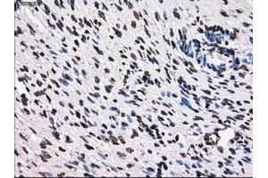 Immunohistochemical staining of paraffin-embedded Adenocarcinoma of breast tissue using anti-TTLL12 mouse monoclonal antibody. (TTLL12 Antikörper)