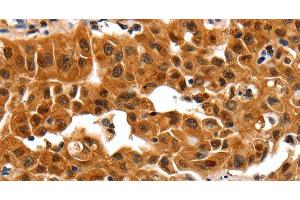 Immunohistochemistry of paraffin-embedded Human lung cancer using 14-3-3 beta/alpha Polyclonal Antibody at dilution of 1:30 (YWHAB Antikörper)