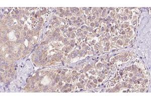 ABIN6273307 at 1/100 staining Human thyroid cancer tissue by IHC-P.
