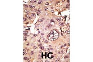 Formalin-fixed and paraffin-embedded human hepatocellular carcinoma tissue reacted with MAPT polyclonal antibody  , which was peroxidase-conjugated to the secondary antibody, followed by AEC staining.