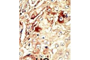 Formalin-fixed and paraffin-embedded human cancer tissue reacted with the primary antibody, which was peroxidase-conjugated to the secondary antibody, followed by AEC staining. (WEE1 Antikörper  (AA 144-173))